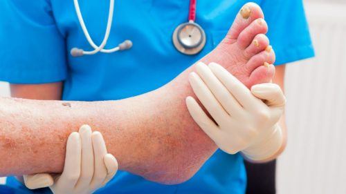 Dijabetičko stopalo - Opis i liječenje